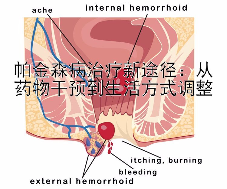 帕金森病治疗新途径：从药物干预到生活方式调整