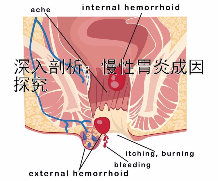 深入剖析：慢性胃炎成因探究