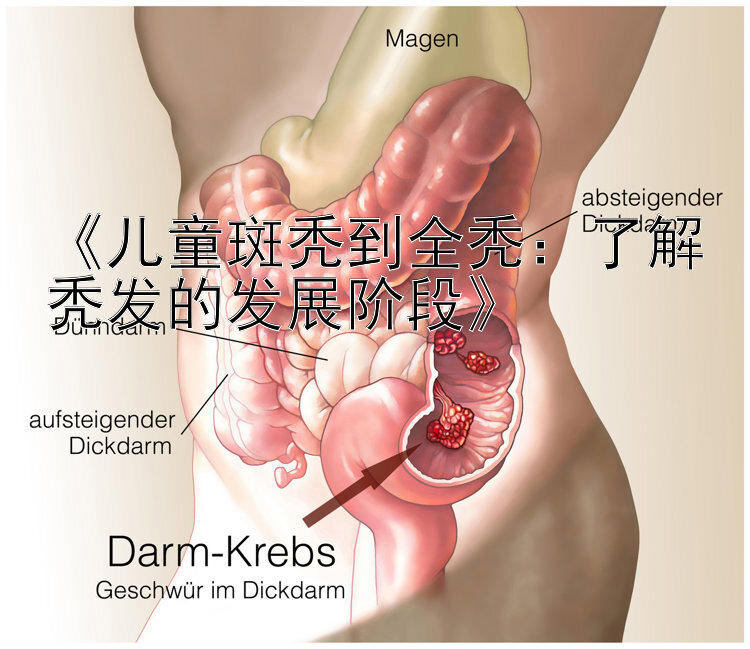 《儿童斑秃到全秃：了解秃发的发展阶段》