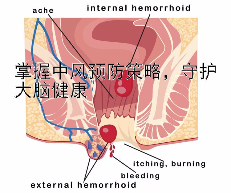 掌握中风预防策略，守护大脑健康