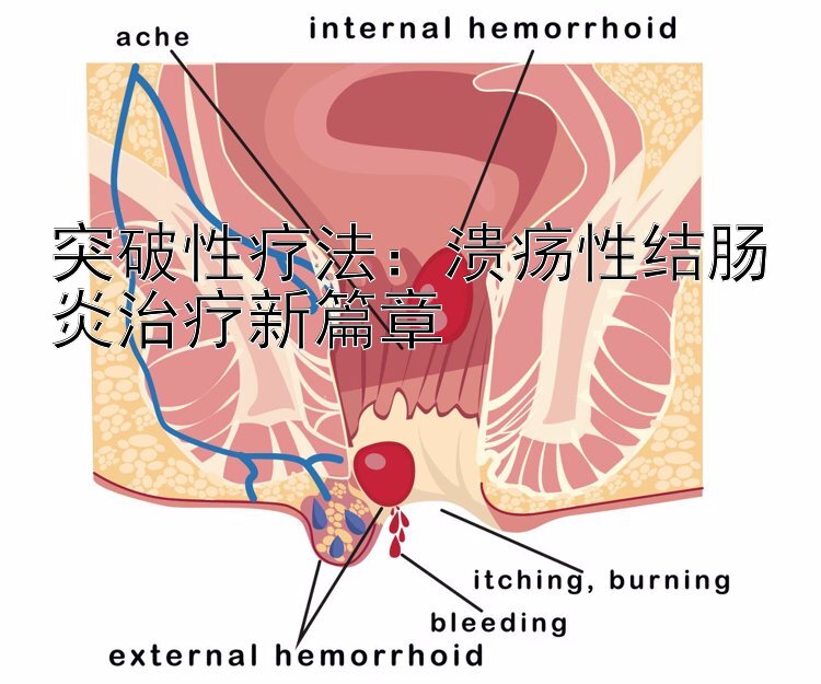 突破性疗法：溃疡性结肠炎治疗新篇章