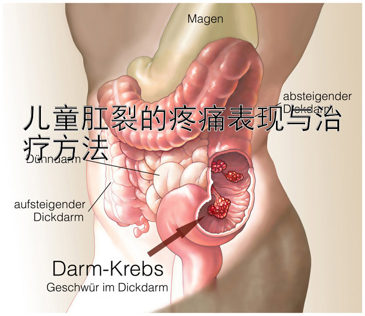 儿童肛裂的疼痛表现与治疗方法