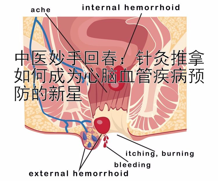 中医妙手回春：针灸推拿如何成为心脑血管疾病预防的新星