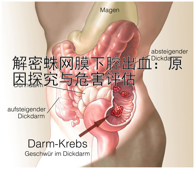 解密蛛网膜下腔出血：原因探究与危害评估