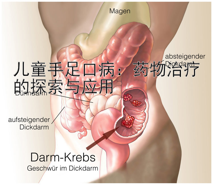 儿童手足口病：药物治疗的探索与应用