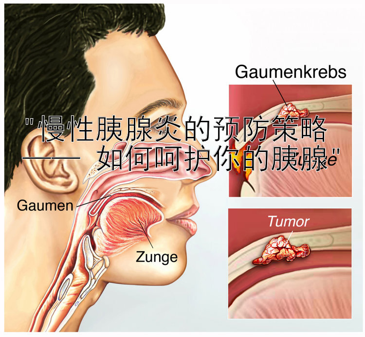 慢性胰腺炎的预防策略 —— 如何呵护你的胰腺