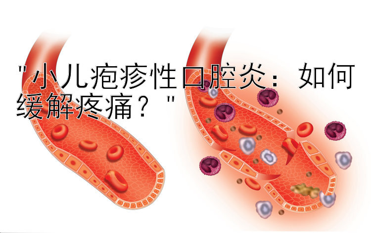 小儿疱疹性口腔炎：如何缓解疼痛？