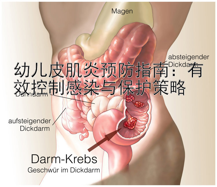 幼儿皮肌炎预防指南：有效控制感染与保护策略