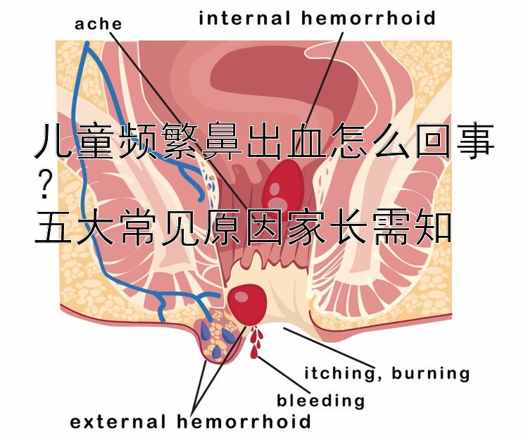 儿童频繁鼻出血怎么回事？  
五大常见原因家长需知